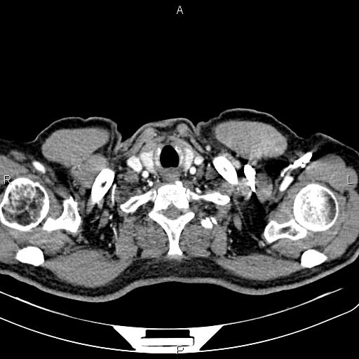 File:Cecal cancer with appendiceal mucocele (Radiopaedia 91080-108651 A 6).jpg
