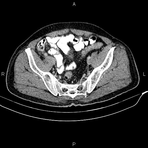 File:Cecal cancer with appendiceal mucocele (Radiopaedia 91080-108651 B 86).jpg