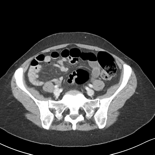 Cecal internal hernia through the foramen of Winslow (Radiopaedia 44820-48651 B 55).png