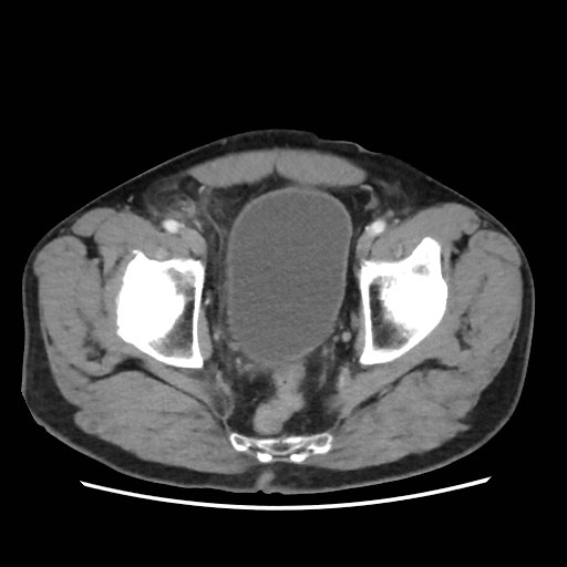 Cecal mass causing appendicitis (Radiopaedia 59207-66531 A 79).jpg