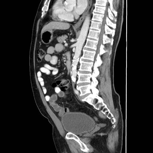 Cecal mass causing appendicitis (Radiopaedia 59207-66531 C 35).jpg