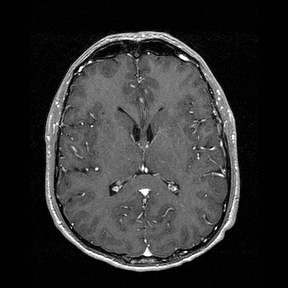Central-variant posterior reversible encephalopathy syndrome (PRES) (Radiopaedia 43880-47358 Axial T1 C+ 89).jpg