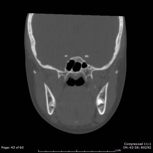 File:Central giant cell granuloma (Radiopaedia 45612-49754 Coronal bone window 43).jpg