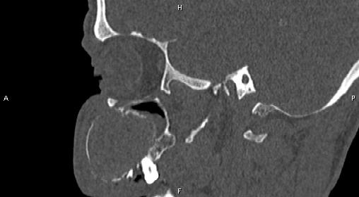File:Central giant cell granuloma (Radiopaedia 83346-97761 Sagittal bone window 15).jpg
