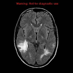 File:Central nervous system vasculitis (Radiopaedia 8410-9235 Axial FLAIR 12).jpg