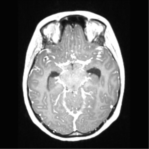Central neurocytoma (Radiopaedia 37664-39557 Axial T1 C+ 33).png