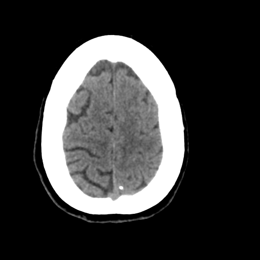 File:Central neurocytoma (Radiopaedia 65317-74346 Axial non-contrast 42).png