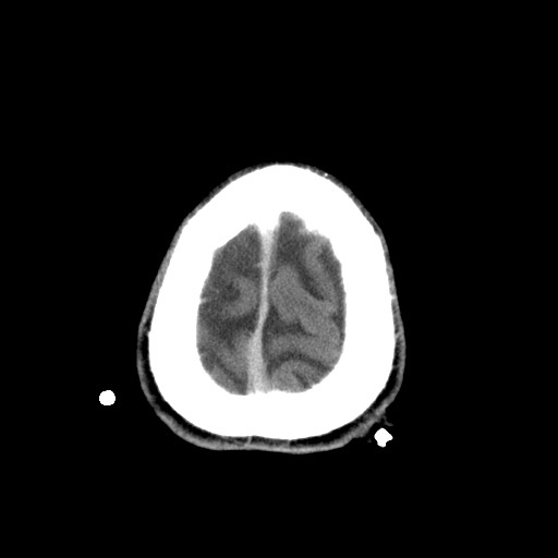 File:Central neurocytoma (Radiopaedia 68725-78432 Axial C+ 86).jpg