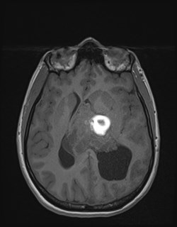 File:Central neurocytoma (Radiopaedia 84497-99872 Axial T1 110).jpg