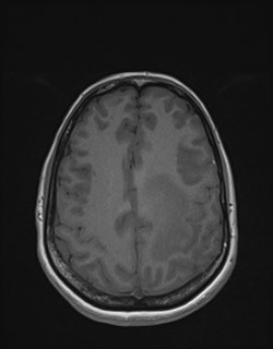 File:Central neurocytoma (Radiopaedia 84497-99872 Axial T1 142).jpg