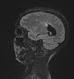 Central neurocytoma (Radiopaedia 84497-99872 Sagittal Flair + Gd 51).jpg