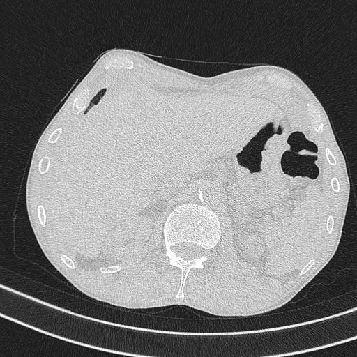 Central venous catheter tip extravasation (Radiopaedia 82828-97113 Axial lung window 81).jpg