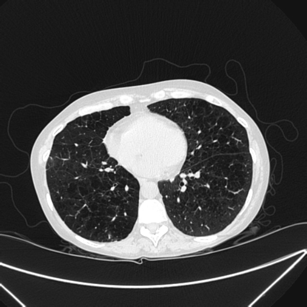 Centrilobular pulmonary emphysema (Radiopaedia 24495-24789 Axial lung window 63).jpg