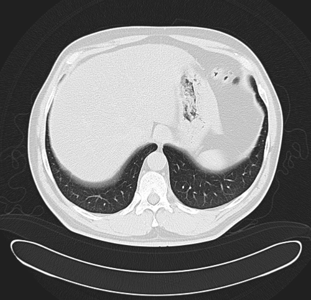 Centrilobular pulmonary emphysema (Radiopaedia 26808-26971 C 39).jpg