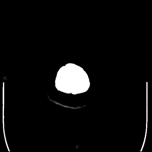 Cerebellar abscess (Radiopaedia 78135-90671 Axial non-contrast 116).jpg