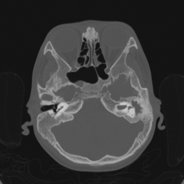 File:Cerebellar abscess secondary to mastoiditis (Radiopaedia 26284-26413 Axial bone window 51).jpg
