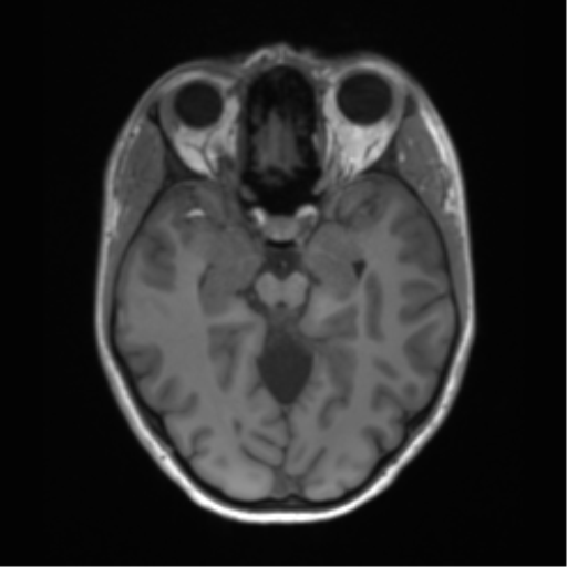 Cerebellar agenesis with hypoplastic pons (pontocerebellar hypoplasia) (Radiopaedia 57224-64138 Axial T1 31).png