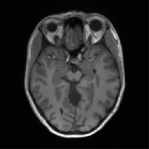 Cerebellar agenesis with hypoplastic pons (pontocerebellar hypoplasia) (Radiopaedia 57224-64138 Axial T1 32).png