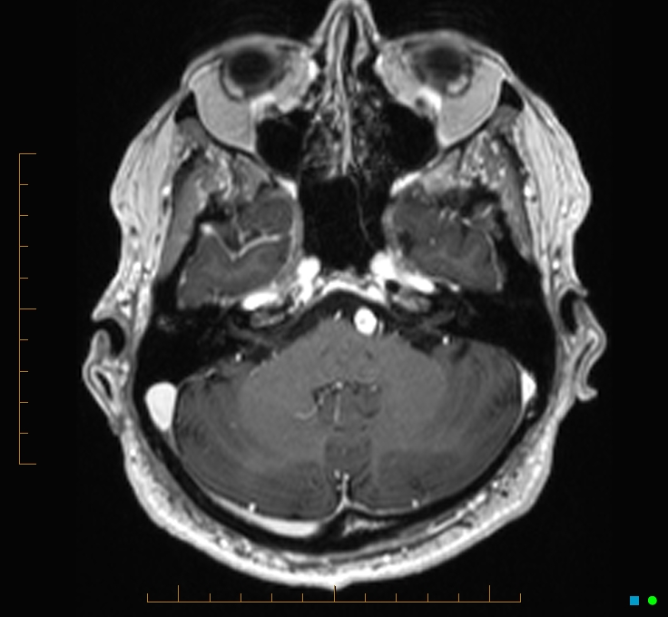 Cerebellar gangliocytoma (Radiopaedia 65377-74422 Axial T1 C+ 24).jpg