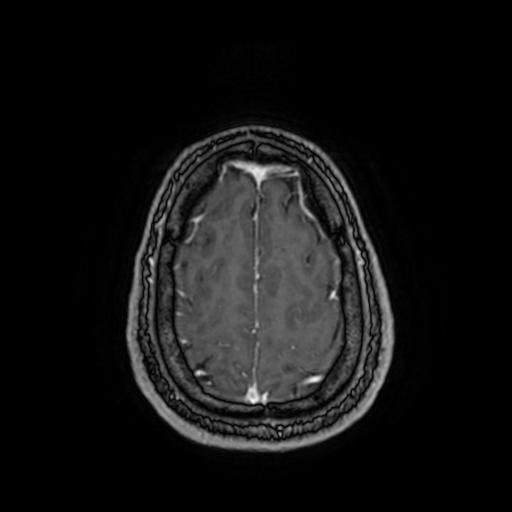 Cerebellar hemangioblastoma (Radiopaedia 88055-104622 Axial T1 C+ 148).jpg