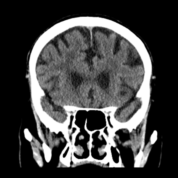 Cerebellar hemorrhage (Radiopaedia 27193-27359 Coronal non-contrast 20).jpg