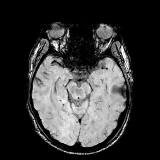 Cerebellar hemorrhage (Radiopaedia 37000-38666 Axial Gradient Echo 34).png