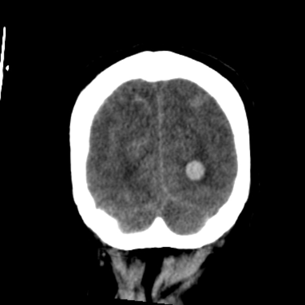Cerebellar hemorrhage causing obstructive hydrocephalus (Radiopaedia 33989-35207 Coronal non-contrast 47).jpg