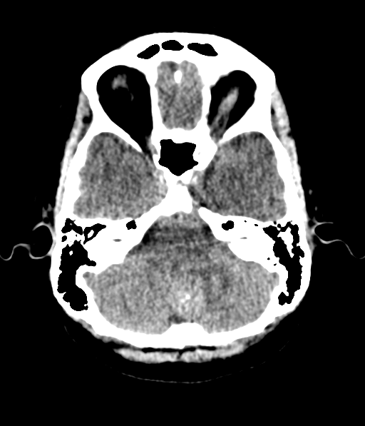 Cerebellar metastases - colorectal adenocarcinoma (Radiopaedia 40947-43652 Axial non-contrast 14).png