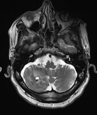 File:Cerebellar metastasis (Radiopaedia 33616-34718 Axial T2 8).png