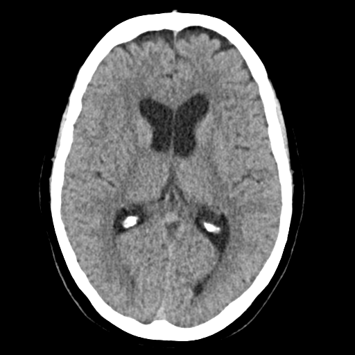 Cerebellar metastasis (Radiopaedia 54578-60812 Axial non-contrast 26).png