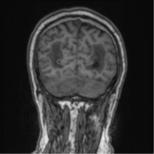 Cerebellar metastasis from lung adenocarcinoma (Radiopaedia 86690-102829 Coronal T1 22).png