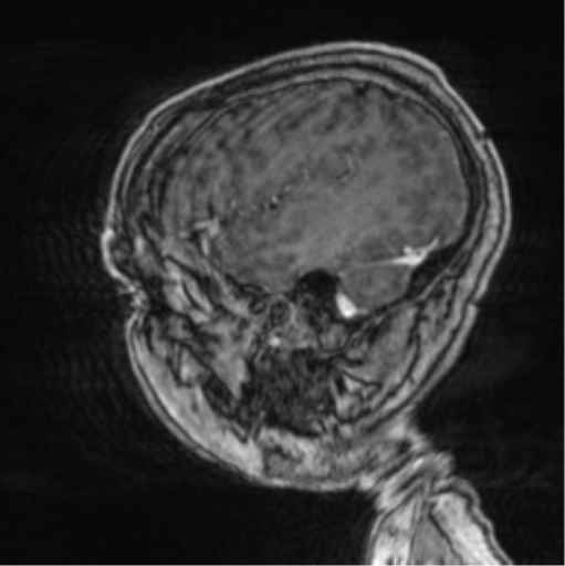 Cerebellar metastasis from lung adenocarcinoma (Radiopaedia 86690-102829 Sagittal T1 C+ 17).png