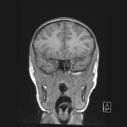 Cerebellar stroke (Radiopaedia 32202-33150 Coronal T1 18).png