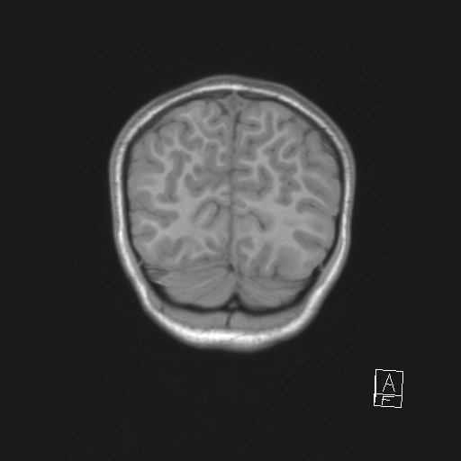 Cerebellar stroke (Radiopaedia 32202-33150 Coronal T1 53).png