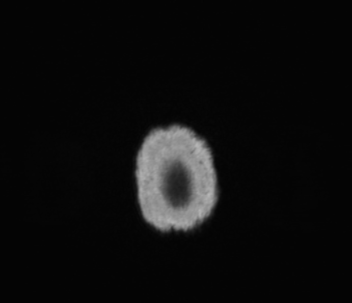 Cerebellopontine angle meningioma (Radiopaedia 35181-36715 Axial T1 C+ 1).jpg