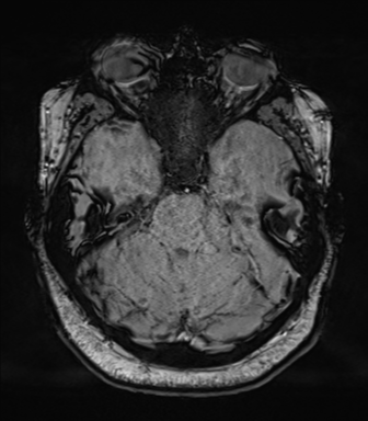 File:Cerebellopontine angle meningioma (Radiopaedia 48434-53348 Axial SWI 29).png