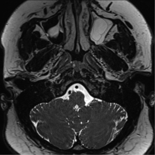 Cerebellopontine angle meningioma (Radiopaedia 48434-53348 Axial T2 Space 27).png