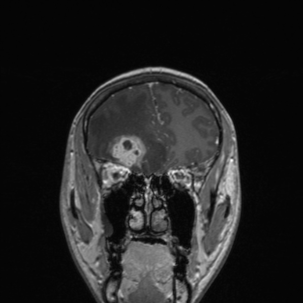 Cerebral abscess (Radiopaedia 24212-24478 Coronal T1 C+ 63).jpg