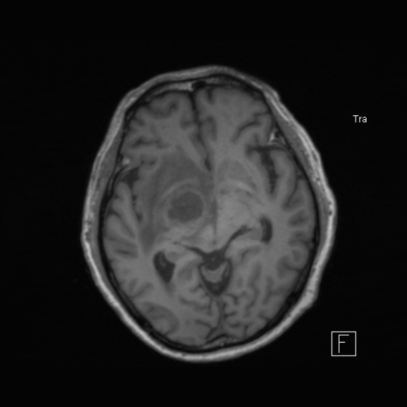 Cerebral abscess (Radiopaedia 26111-26247 Axial T1 30).jpg