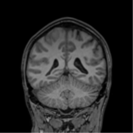 Cerebral abscess (Radiopaedia 60342-68009 Coronal T1 14).png