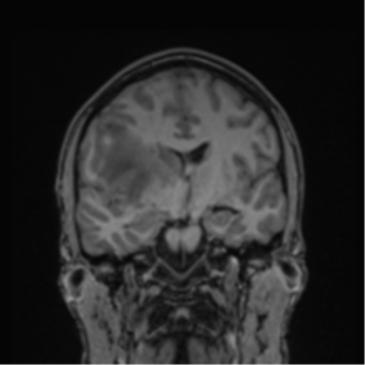Cerebral abscess (Radiopaedia 60342-68009 Coronal T1 26).png