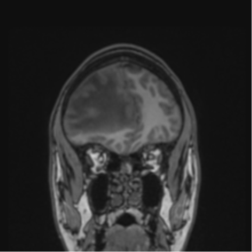 Cerebral abscess (Radiopaedia 60342-68009 Coronal T1 42).png