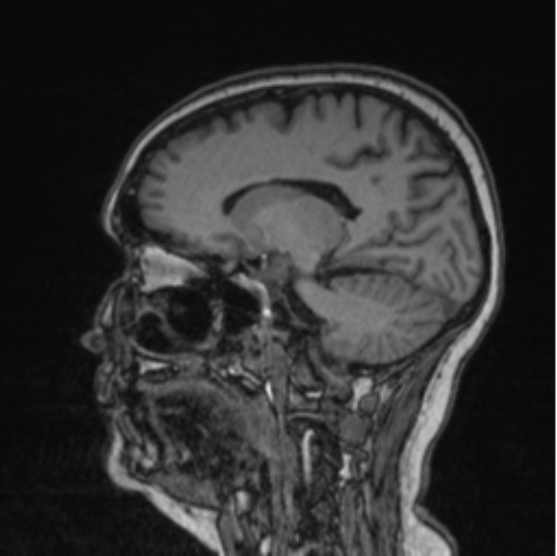 Cerebral abscess from pulmonary arteriovenous malformation (Radiopaedia 86275-102291 Sagittal T1 46).png