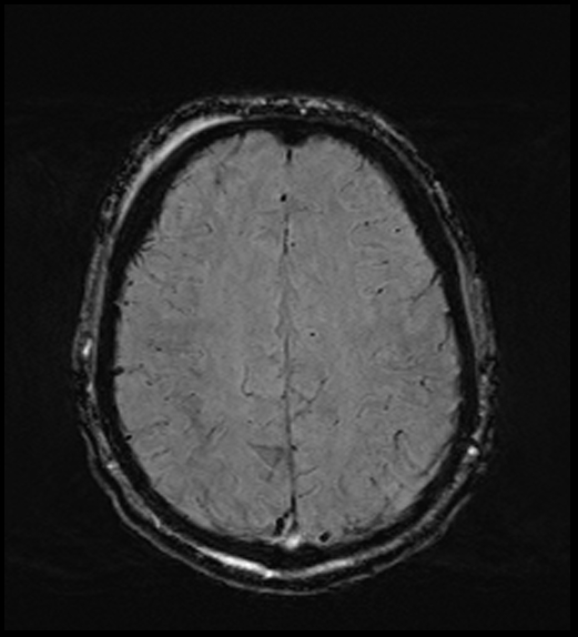 Cerebral abscess with ventriculitis (Radiopaedia 78965-91878 Axial SWI 39).jpg