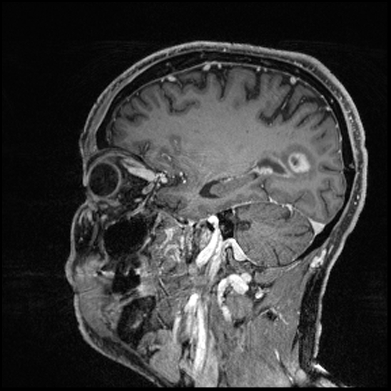 Cerebral abscess with ventriculitis (Radiopaedia 78965-91878 Sagittal T1 C+ 59).jpg