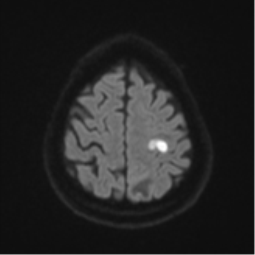 Cerebral abscesses- medically managed (Radiopaedia 45183-49179 Axial DWI 51).png