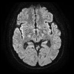 Cerebral amyloid angiopathy (Radiopaedia 28698-28978 Axial DWI 13).jpg