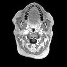 Cerebral amyloid angiopathy (Radiopaedia 29129-29518 Axial T1 C+ 1).jpg