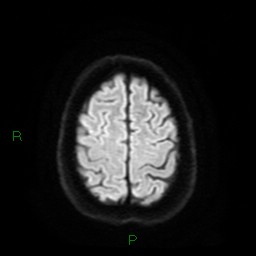 Cerebral amyloid angiopathy (Radiopaedia 77506-89664 Axial DWI 24).jpg