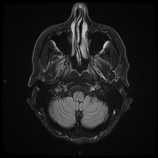 File:Cerebral amyloid angiopathy (Radiopaedia 77506-89664 Axial FLAIR 5).jpg